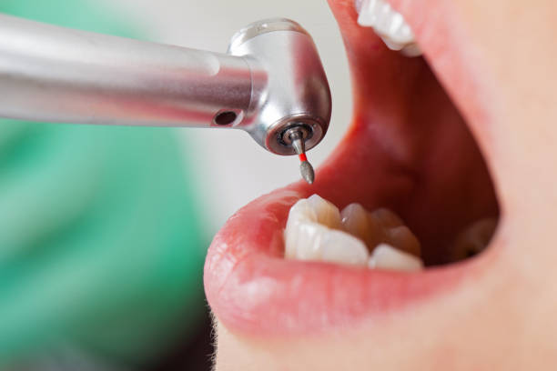Best Emergency Tooth Extraction in Holstein, IA